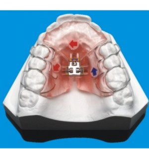 سلسلة تقويم الأسنان